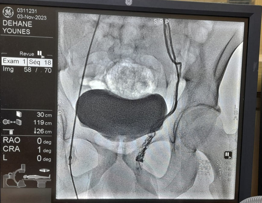 ماذا يقصد بالقسطرة لعلاج دوالي الخصية 